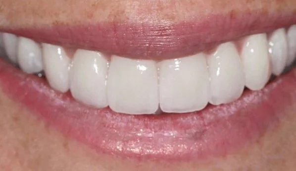 Smile Design 4 After - Cosmetic Dental Studios NYC