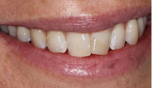 Smile Design 4 Before - Cosmetic Dental Studios NYC