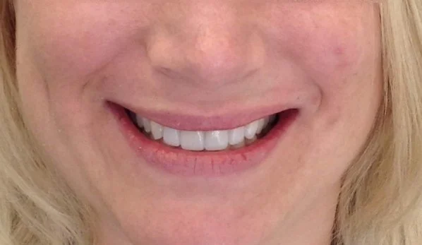 Smile Design 5 After - Cosmetic Dental Studios NYC