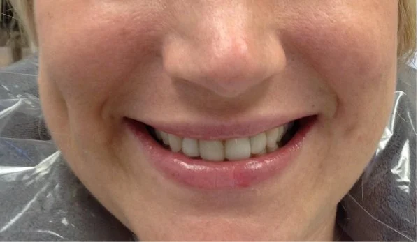 Smile Design 5 Before - Cosmetic Dental Studios NYC