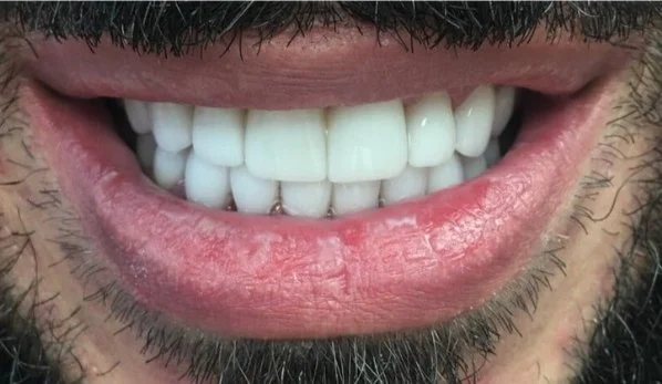 Smile Design 6 After - Cosmetic Dental Studios NYC
