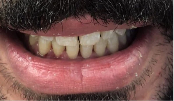 Smile Design 6 Before - Cosmetic Dental Studios NYC
