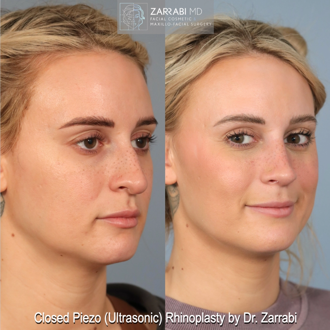 Closed Piezo (Ultrasonic) Rhinoplasty by Dr. Zarrabi - before and after side profile showing refined nose with improved balance