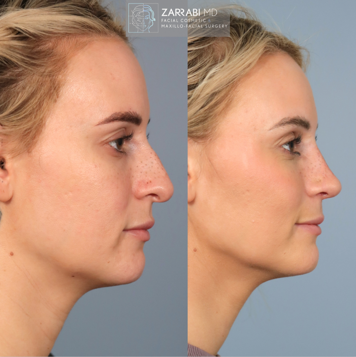 Before and after side profile showing facial contouring results with refined nose and chin definition