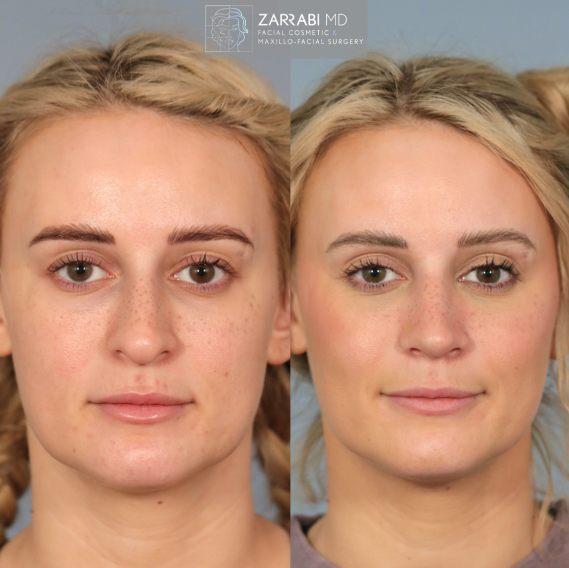 Before and after frontal view showing improved facial symmetry and skin refinement