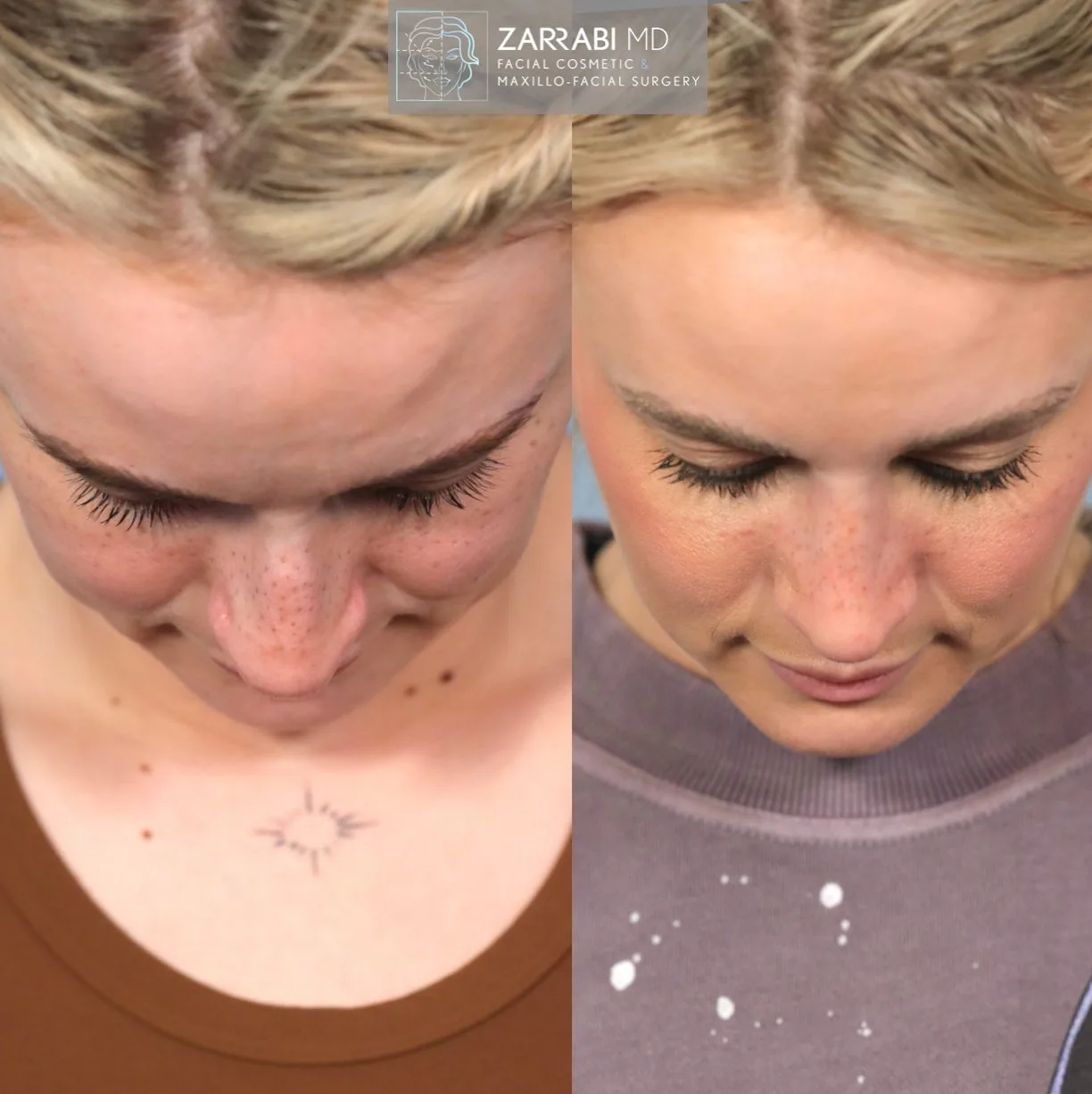 Before and after overhead view showing chin and neck contouring with improved definition