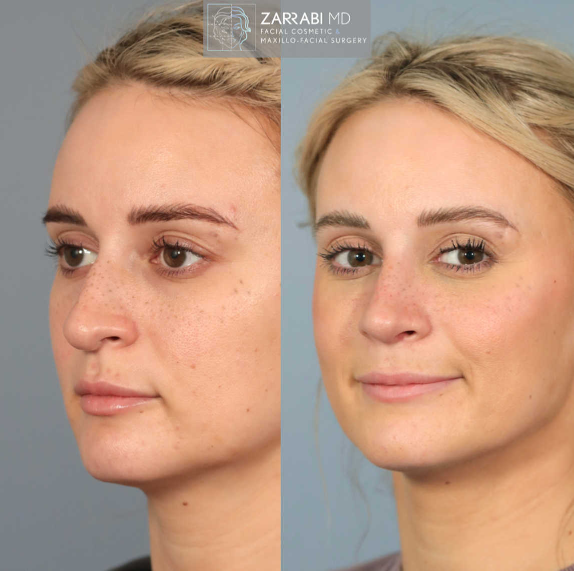 Before and after three-quarter view showing refined facial contours and enhanced cheekbone structure