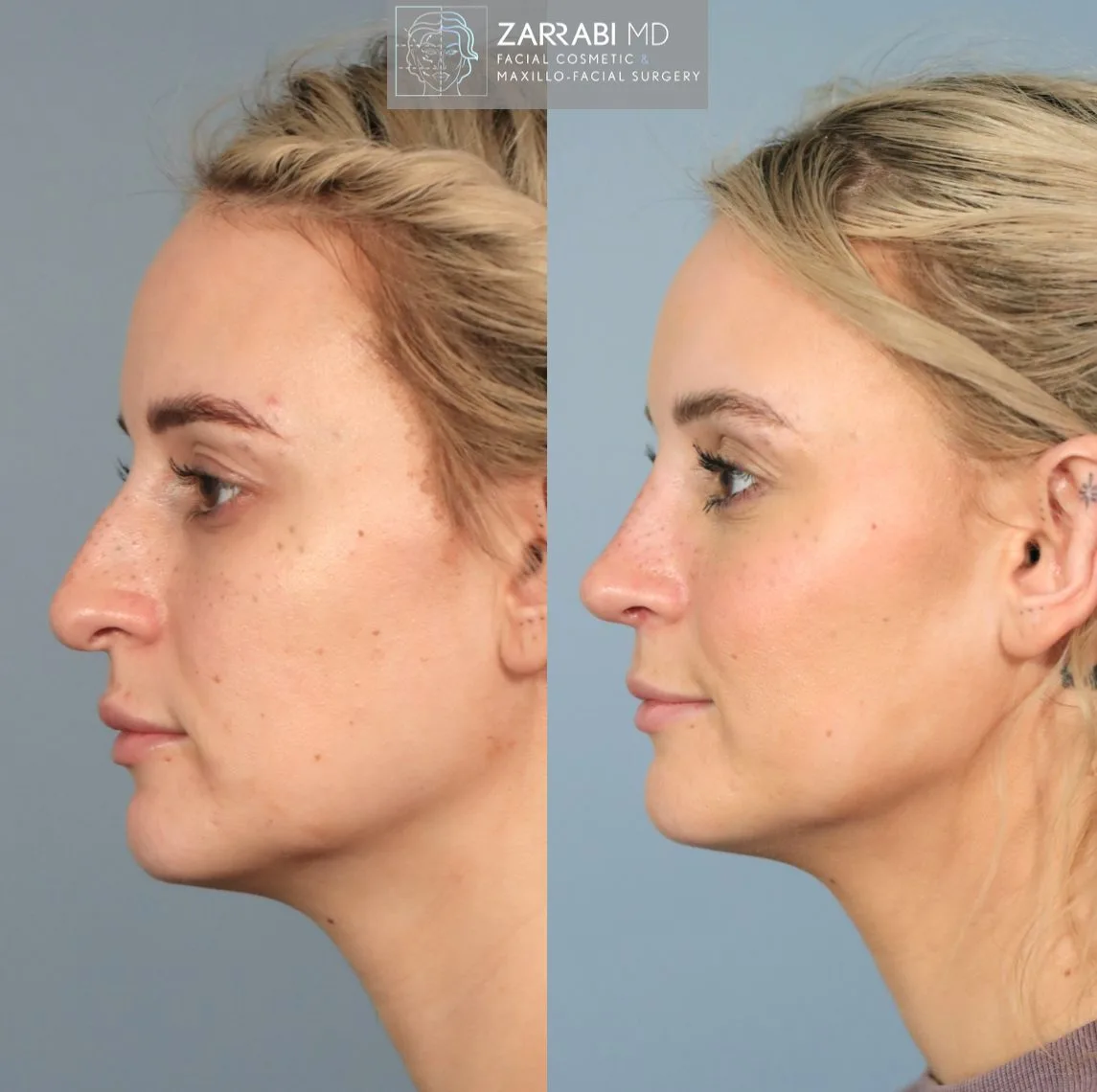 Before and after side profile showing nose refinement and improved facial balance