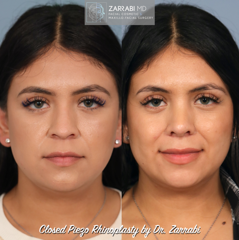 Closed Piezo Rhinoplasty 1 1