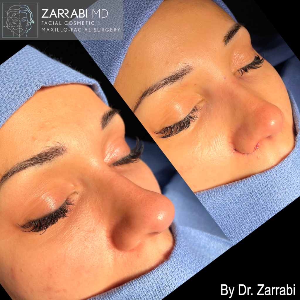 Closed Piezo Rhinoplasty 1 12