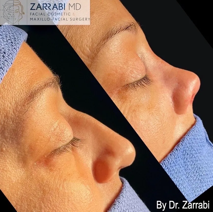 Closed Piezo Rhinoplasty 1 13