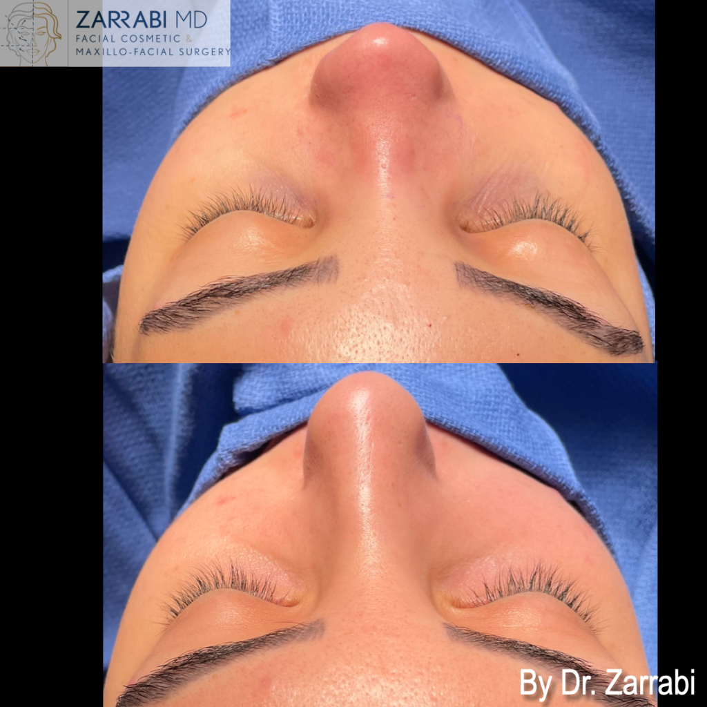 Closed Piezo Rhinoplasty 1 15