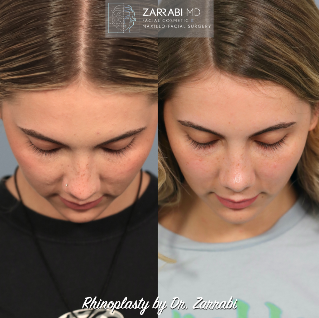 Closed Piezo Rhinoplasty 1 3
