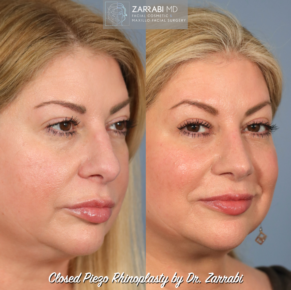 Closed Piezo Rhinoplasty 1