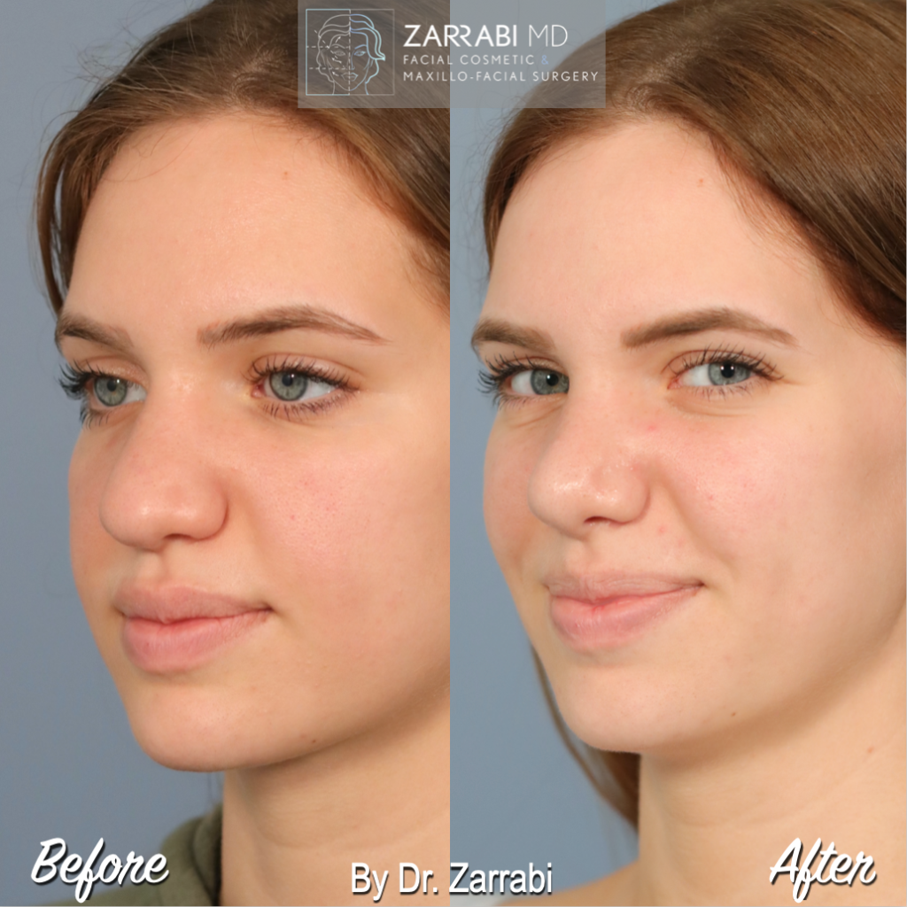 Closed Piezo Rhinoplasty 2 10