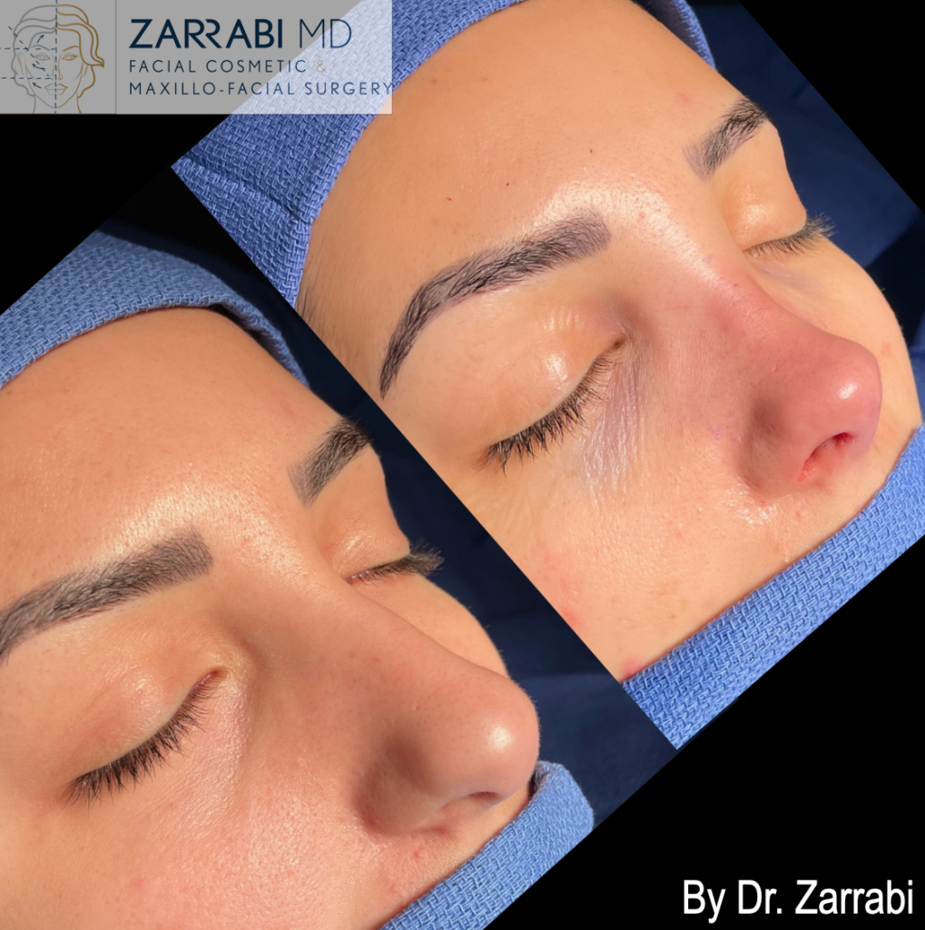 Closed Piezo Rhinoplasty 2 13