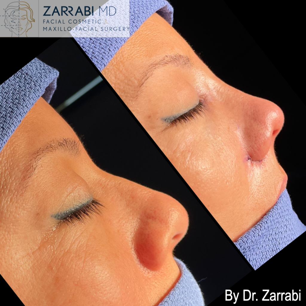 Closed Piezo Rhinoplasty 2 15