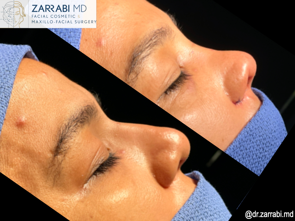 Closed Piezo Rhinoplasty 2 18