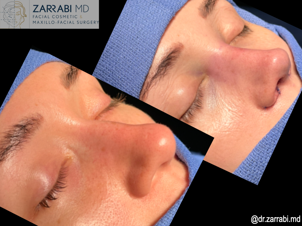 Closed Piezo Rhinoplasty 2 19