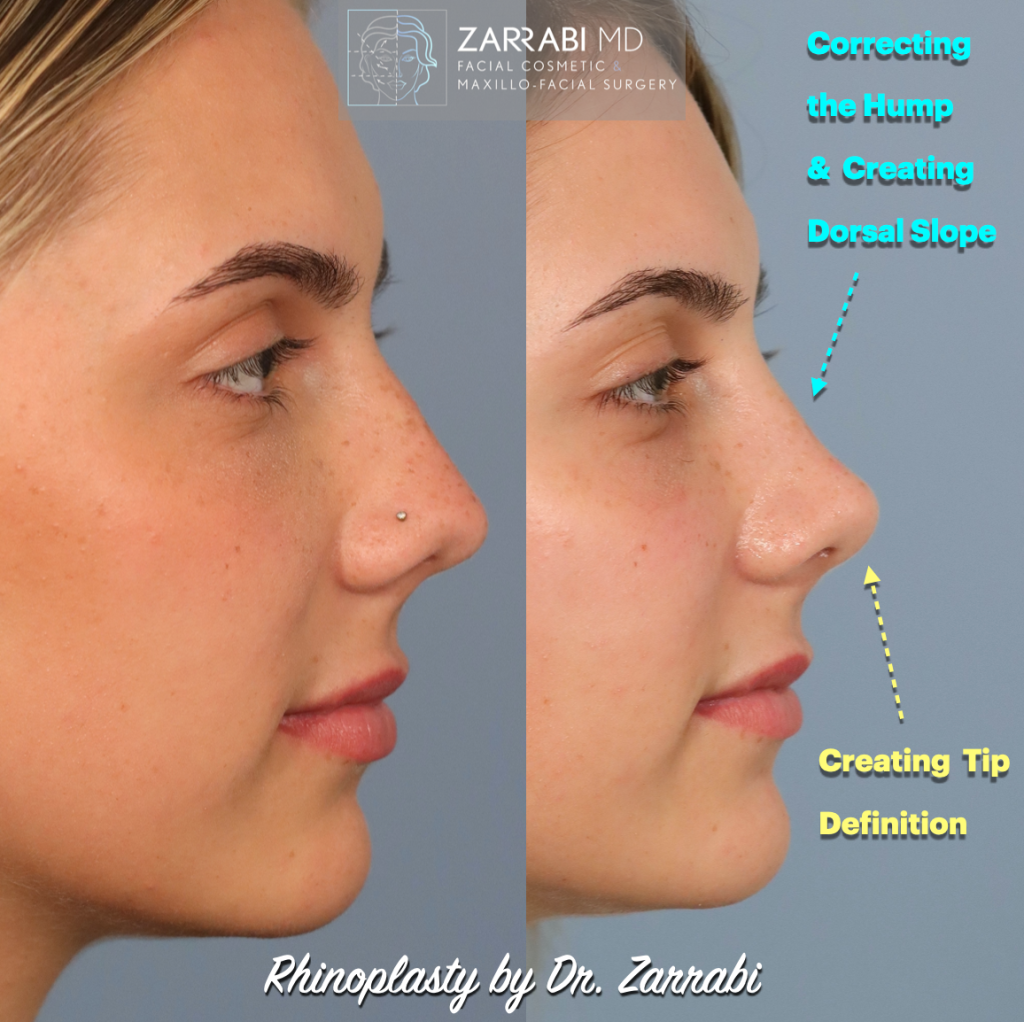 Closed Piezo Rhinoplasty 2 3