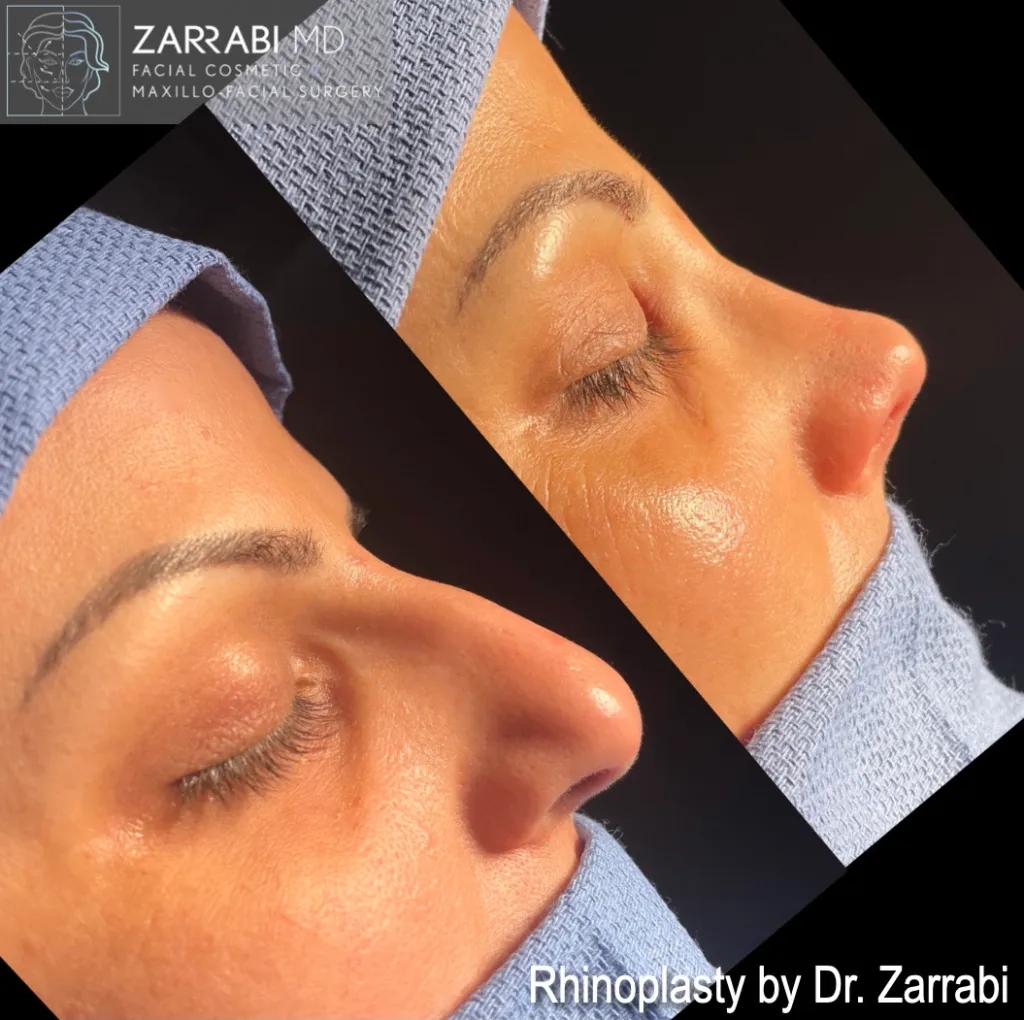 Closed Piezo Rhinoplasty 2 4