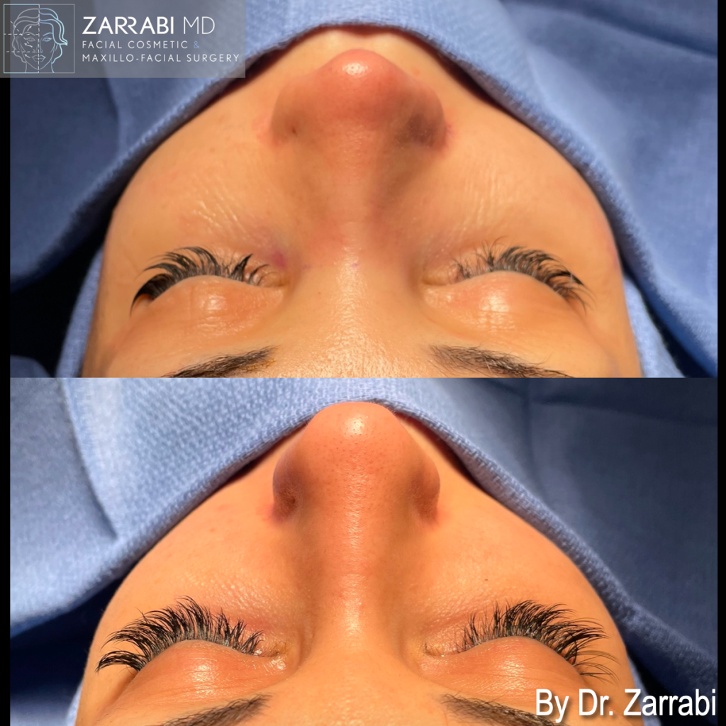 Closed Piezo Rhinoplasty 3 10