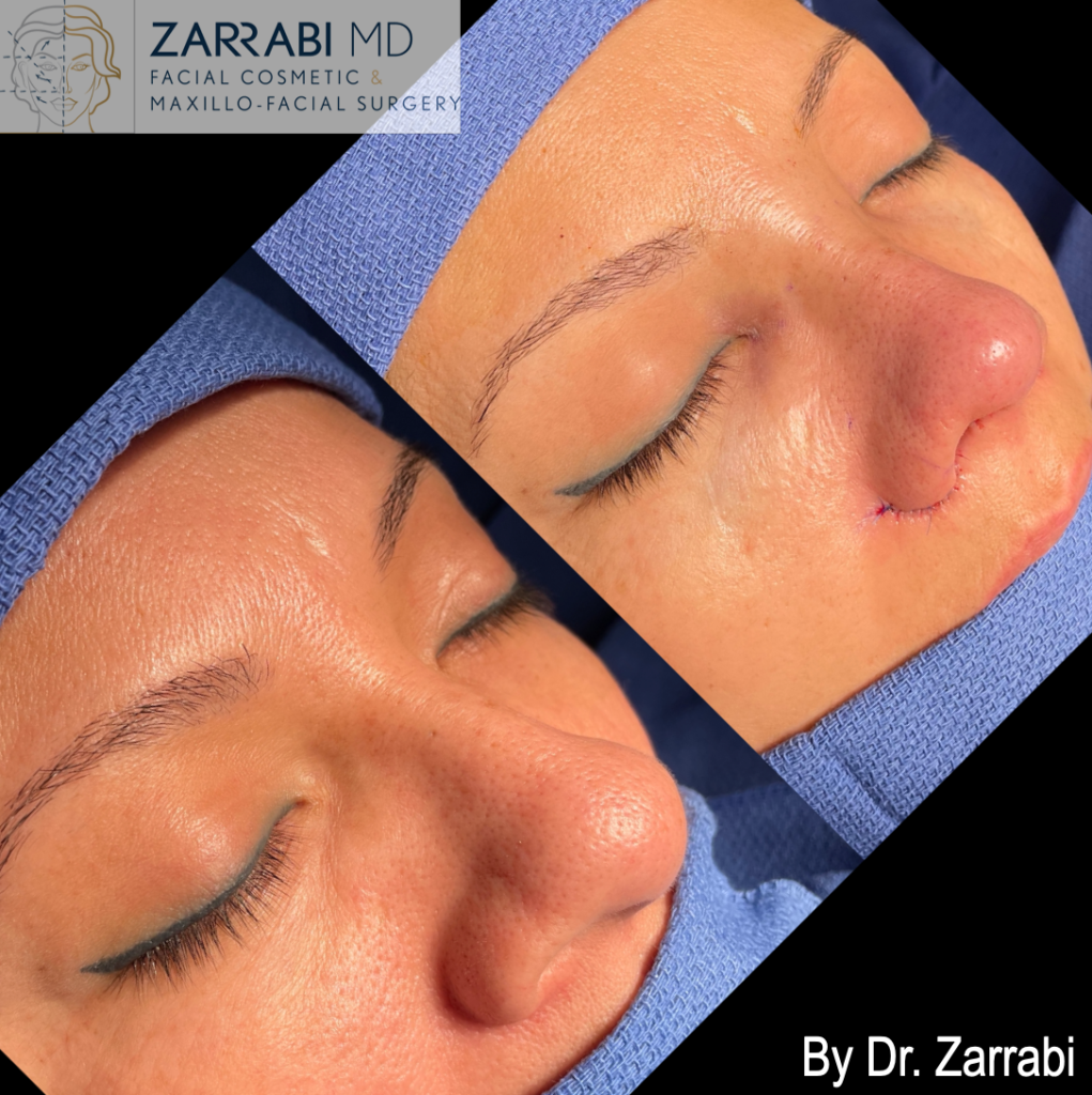 Closed Piezo Rhinoplasty 3 11