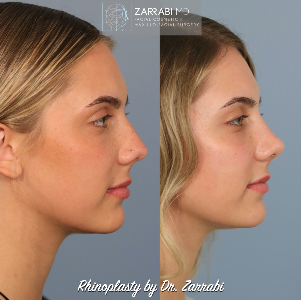 Closed Piezo Rhinoplasty 3 3