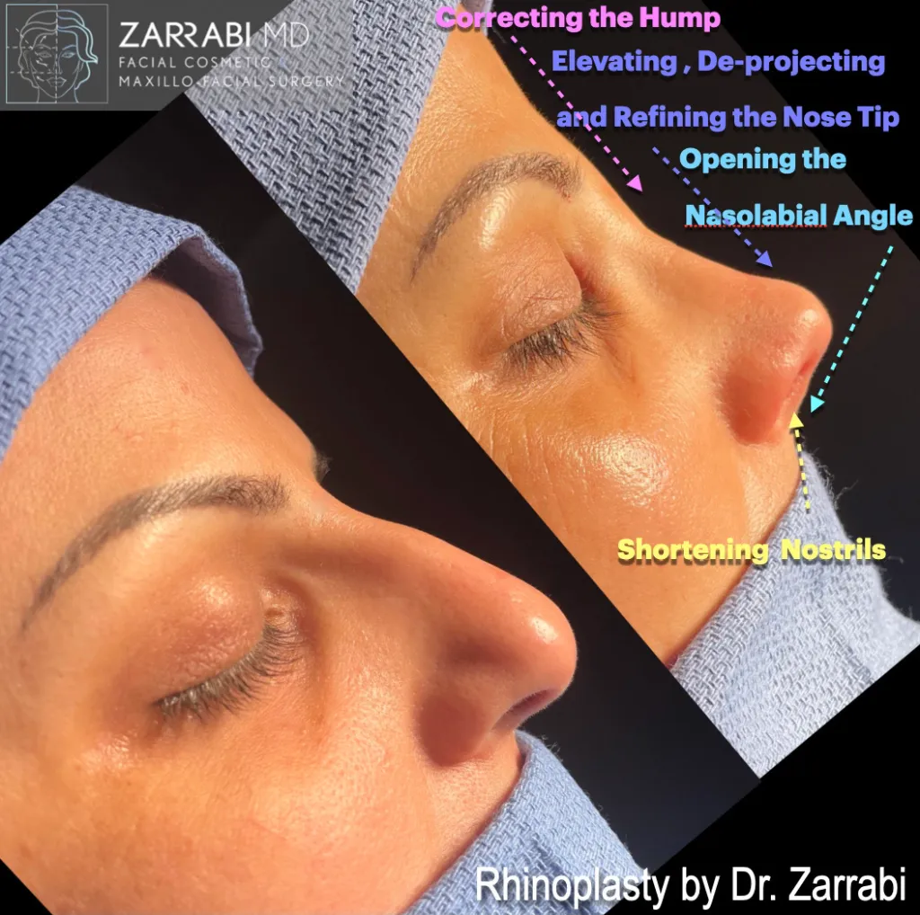 Closed Piezo Rhinoplasty 3 4
