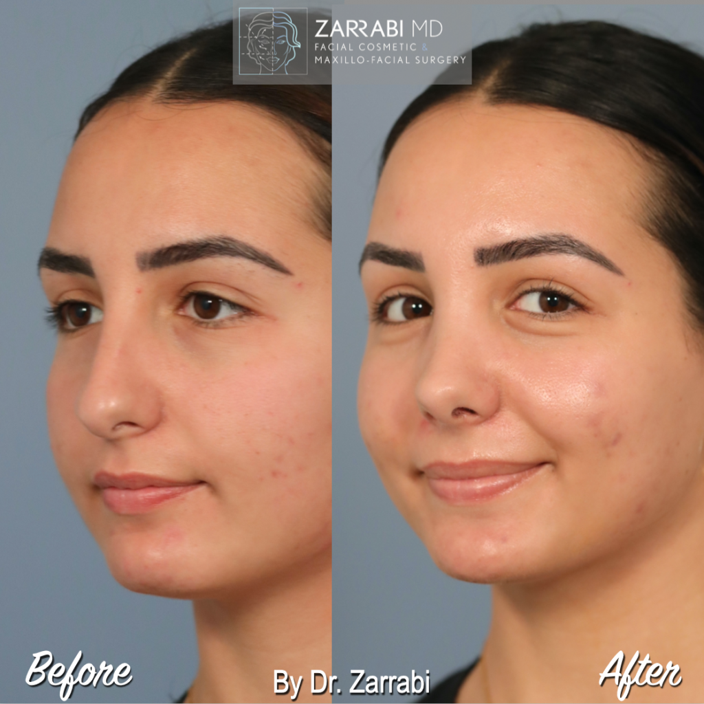Closed Piezo Rhinoplasty 3 7