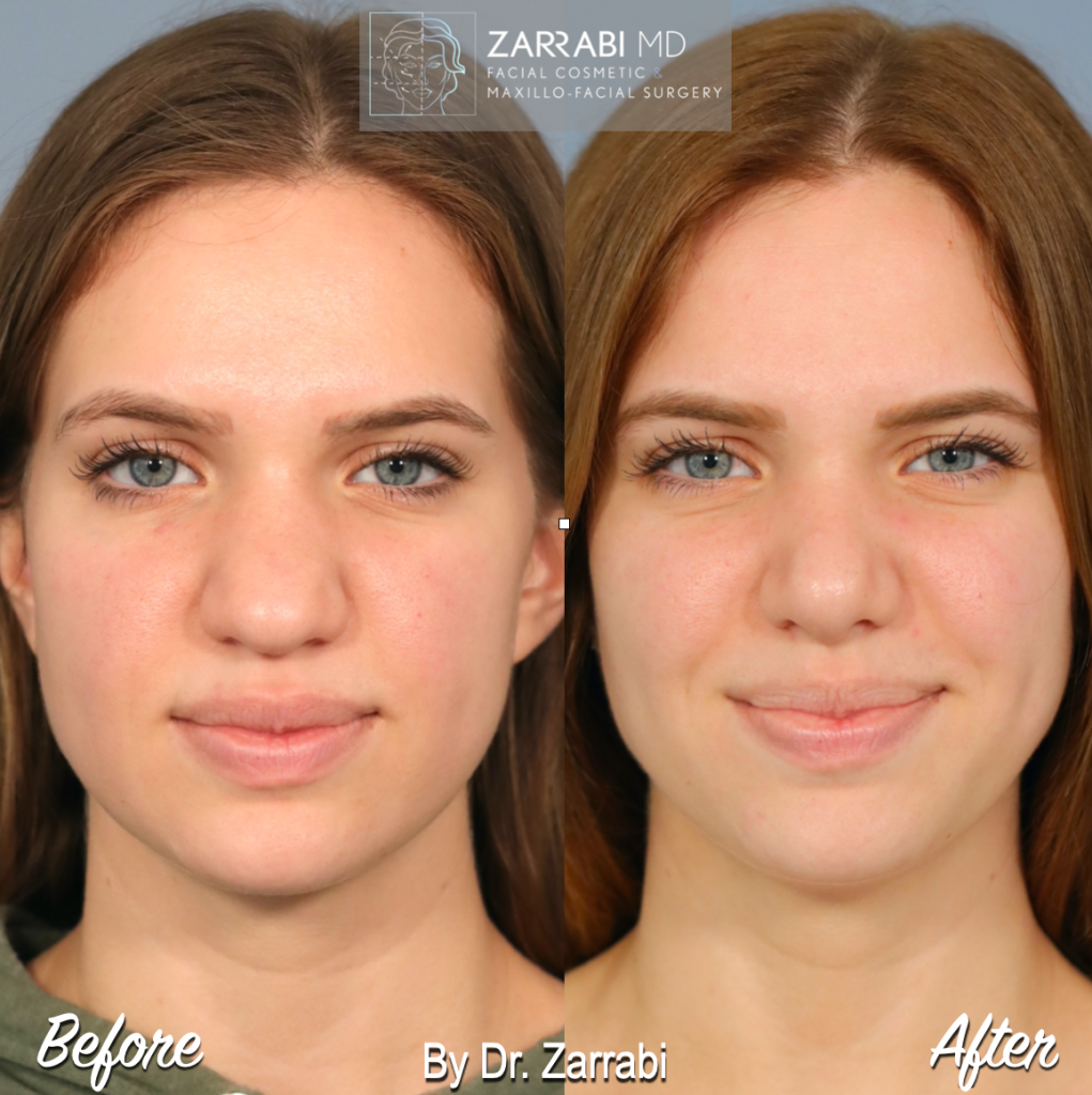 Closed Piezo Rhinoplasty 3 9