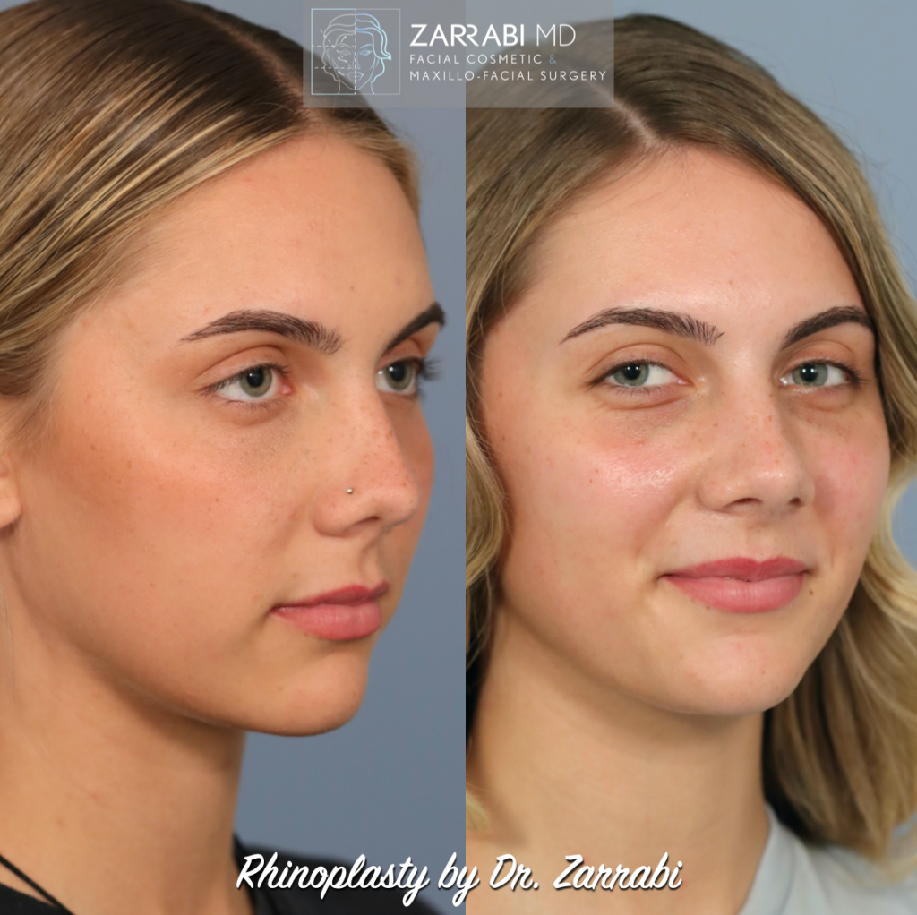 Closed Piezo Rhinoplasty 4 3