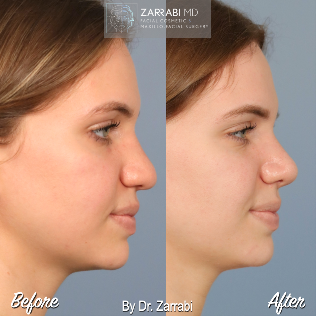 Closed Piezo Rhinoplasty 4 7