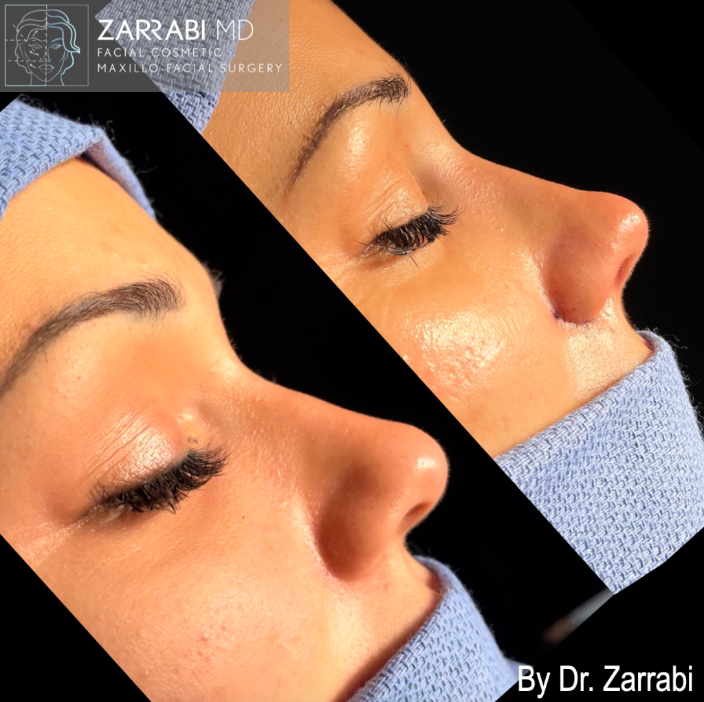 Closed Piezo Rhinoplasty 4 8