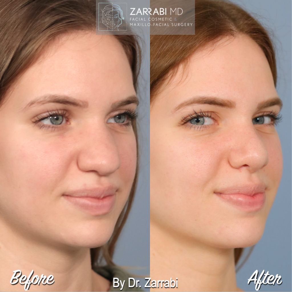 Closed Piezo Rhinoplasty 5 6