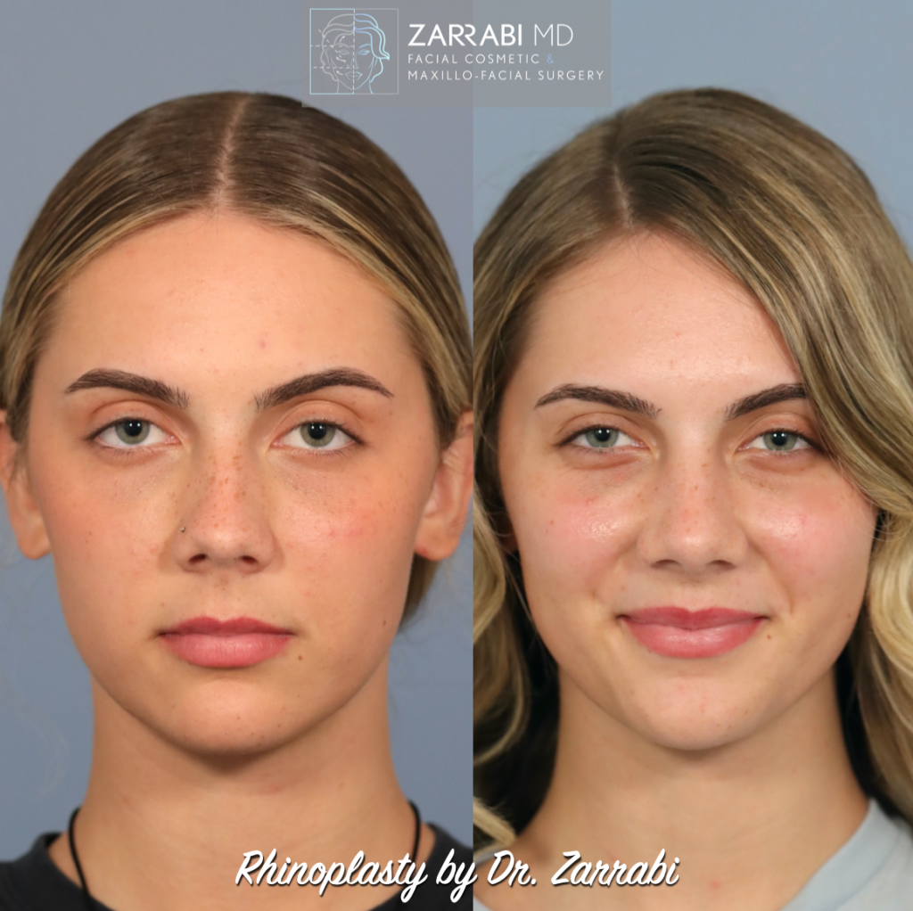 Closed Piezo Rhinoplasty 6 3
