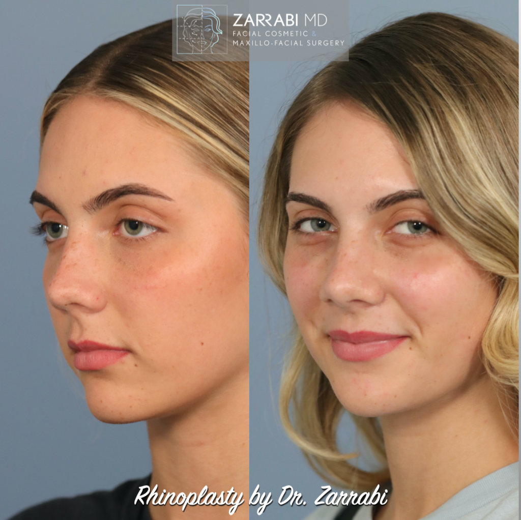 Closed Piezo Rhinoplasty 7 1
