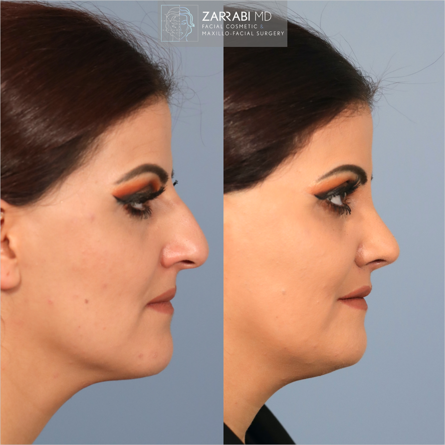 Closed Piezo Rhinoplasty Reduction Genioplasty 6