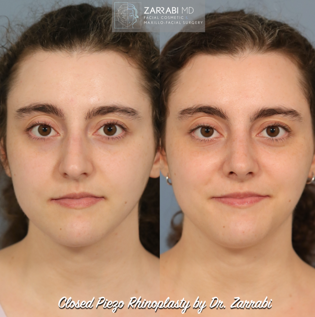Closed Piezo Ultrasonic Rhinoplasty 2 1