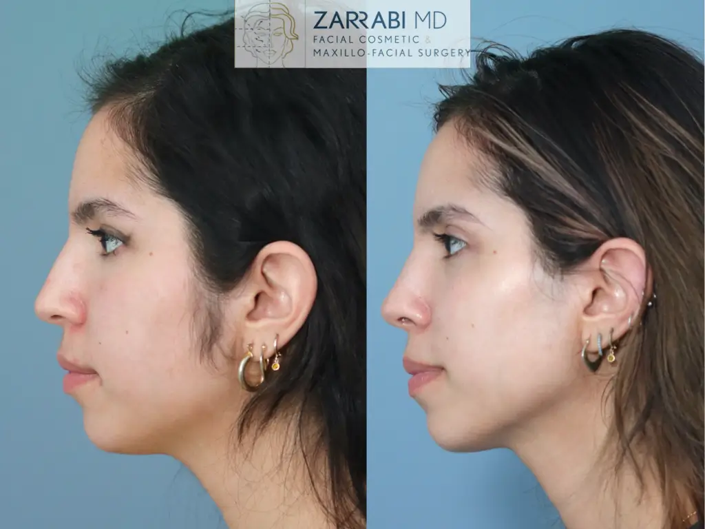 Closed-Preservation-Rhinoplasty-2