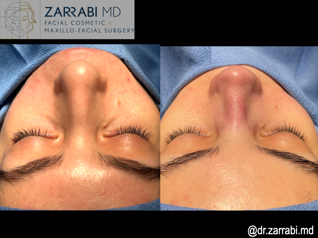 Closed Rhinoplasty Before After 2