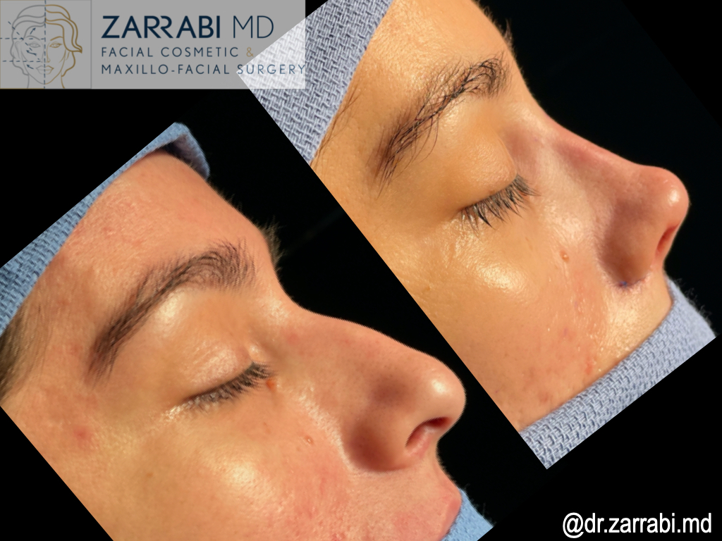Closed Rhinoplasty Before After 3