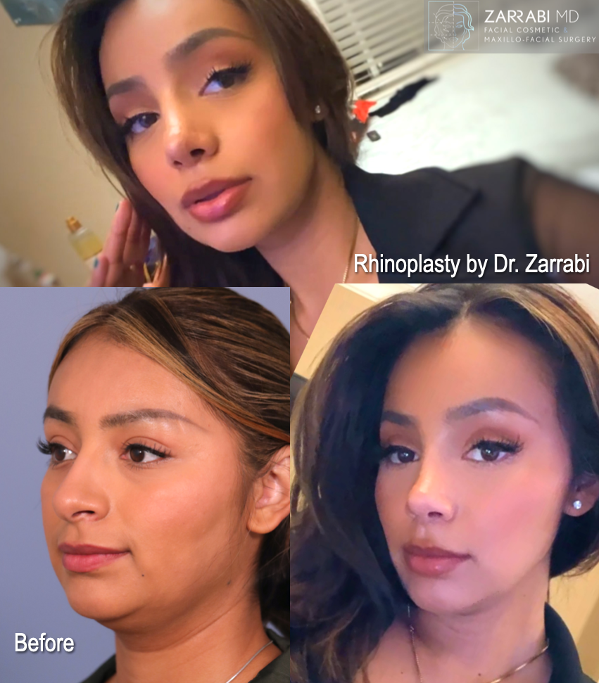 Closed Ultrasonic Piezo Rhinoplasty