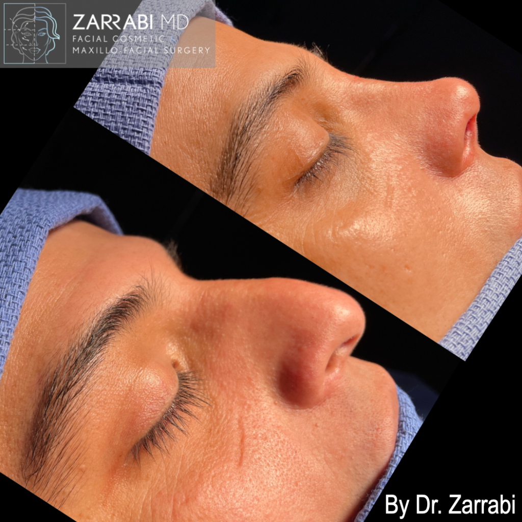 Closed Ultrasonic Rhinoplasty 1 6