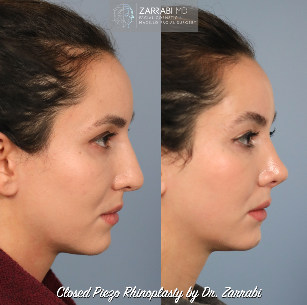 Closed Ultrasonic Rhinoplasty 1