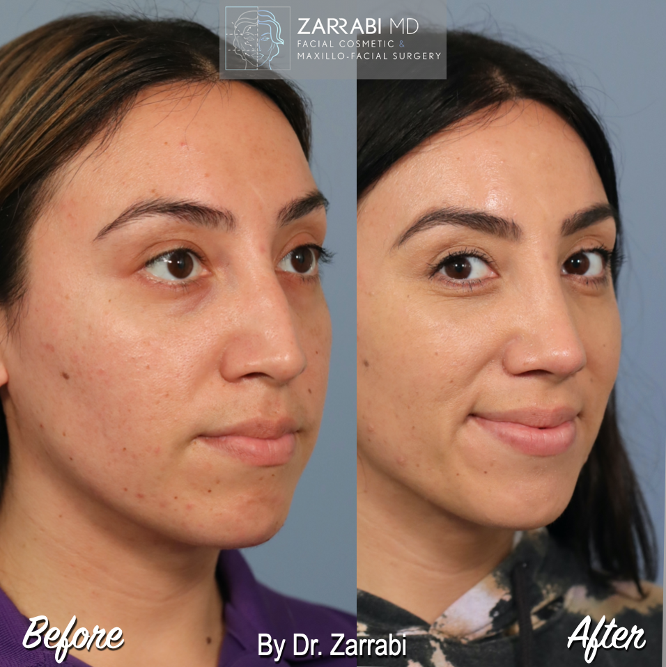 Closed Ultrasonic Rhinoplasty 2 3