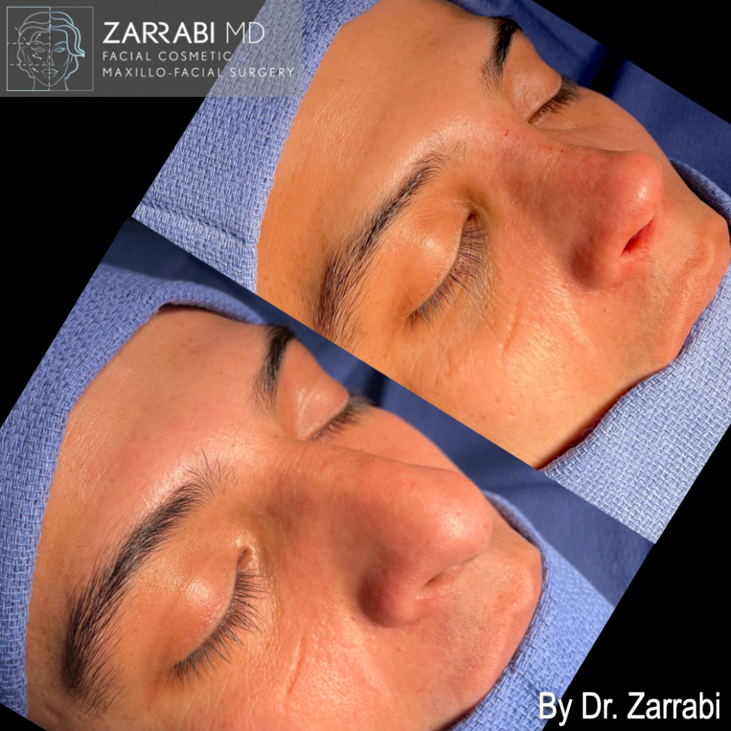 Closed Ultrasonic Rhinoplasty 2 6