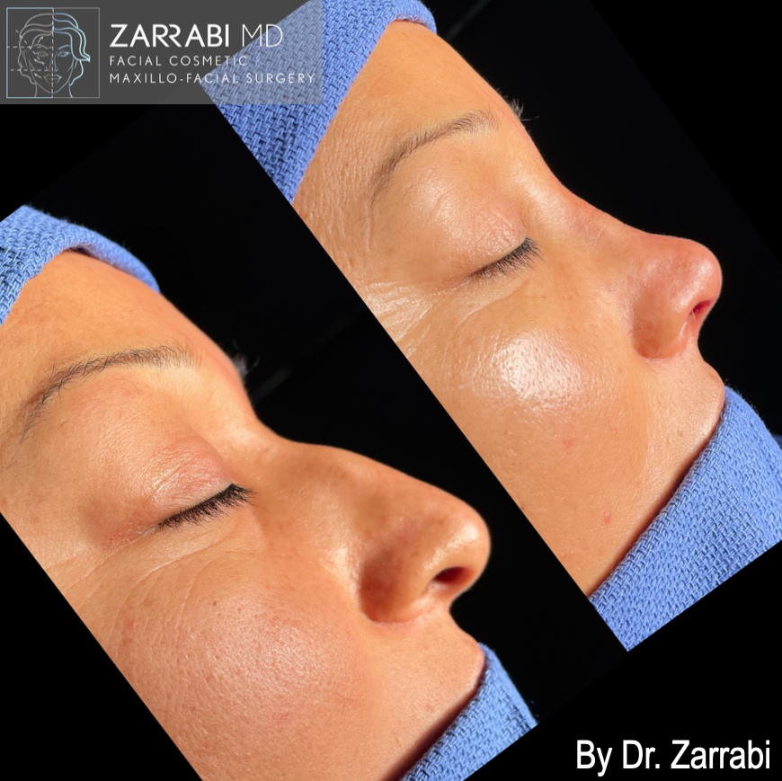 Closed Ultrasonic Rhinoplasty 2 7