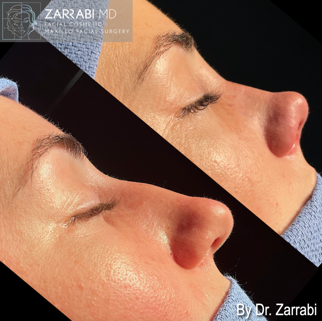 Closed Ultrasonic Rhinoplasty 2 8