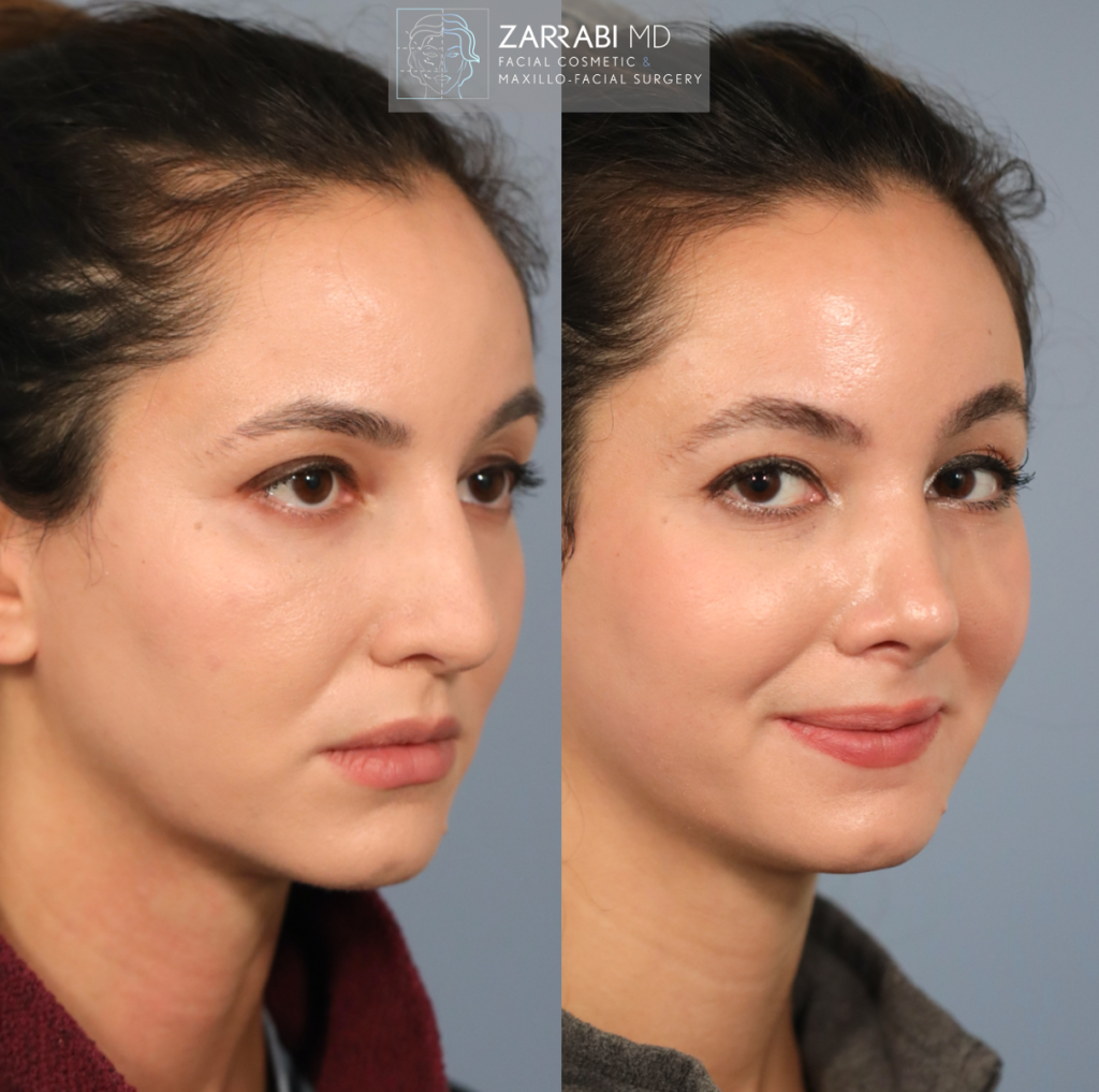 Closed Ultrasonic Rhinoplasty 2